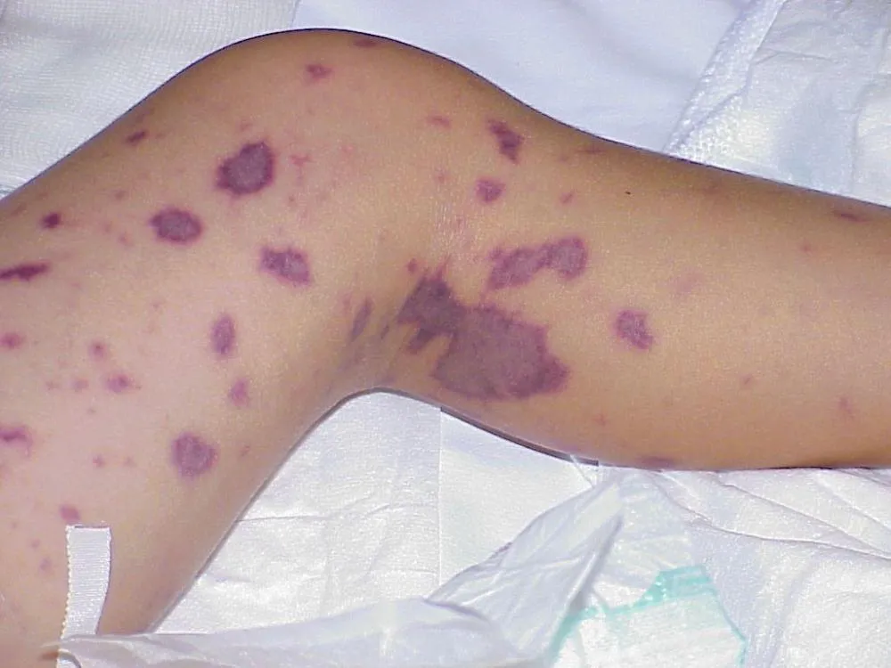 Principais sintomas da doença são manchas arroxeadas na pele, rigidez na nuca e sensibilidade à luz. Foto: Reprodução/Internet