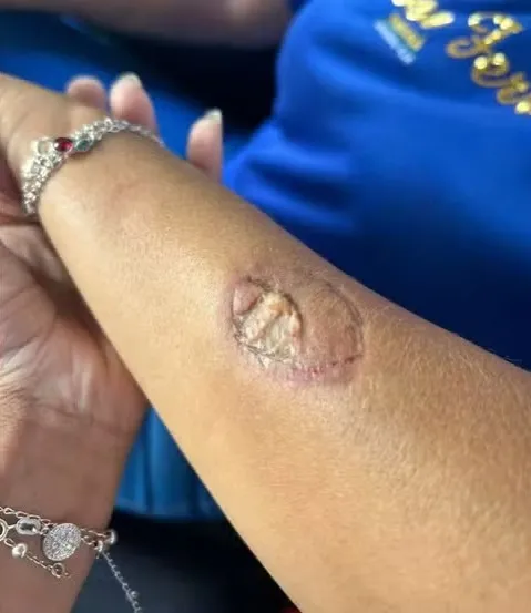 Vice-diretora foi mordida pela mulher durante a confusão. Foto: Arquivo Pessoal